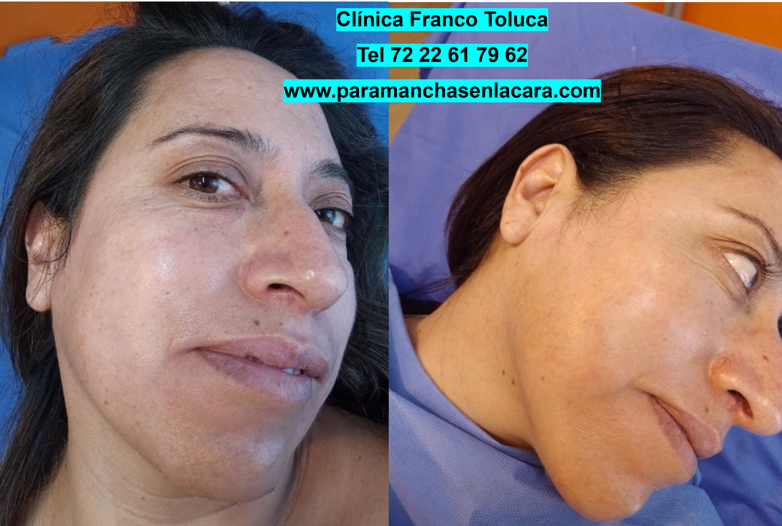 paciente con melasma resuelto