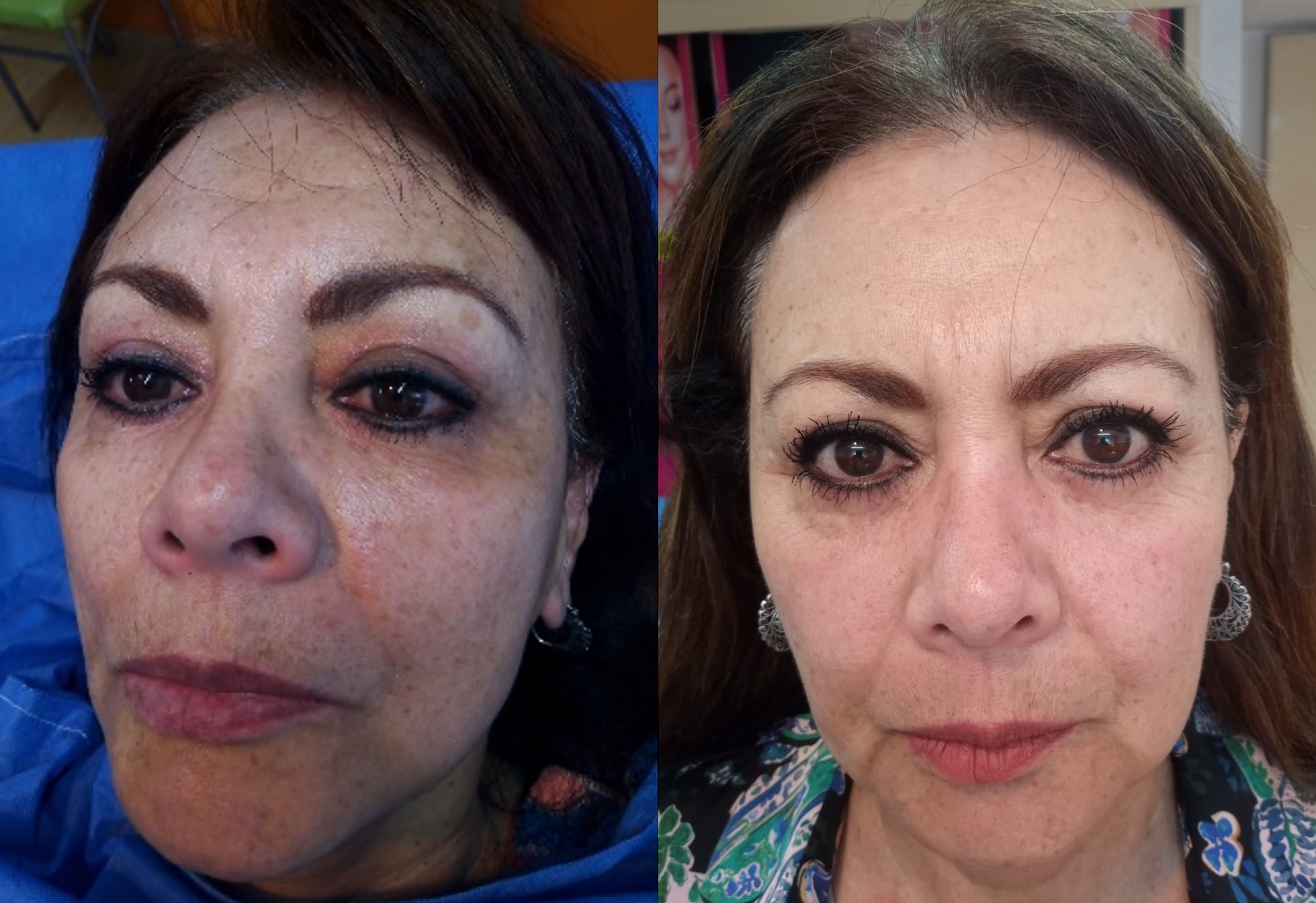 tratamiento para melasma en la cara y otras manchas