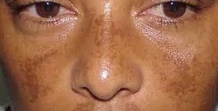 manchas de melasma dificiles de quitar