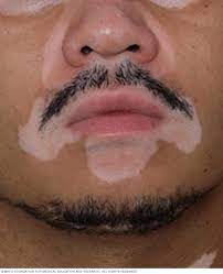 paciente con vitiligo en tratamiento para las manchas en la cara