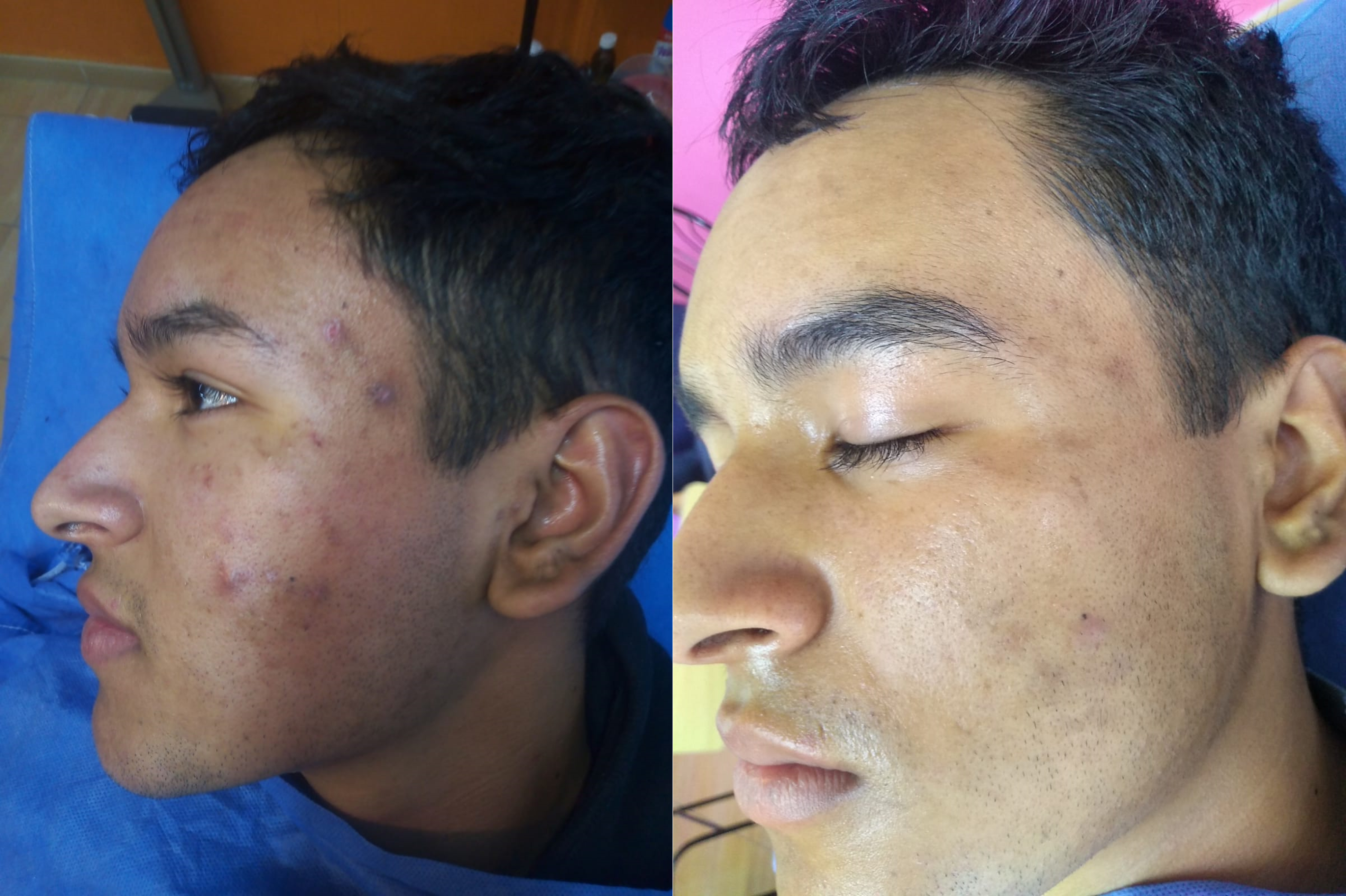 tratamiento para manchas en la cara por acne