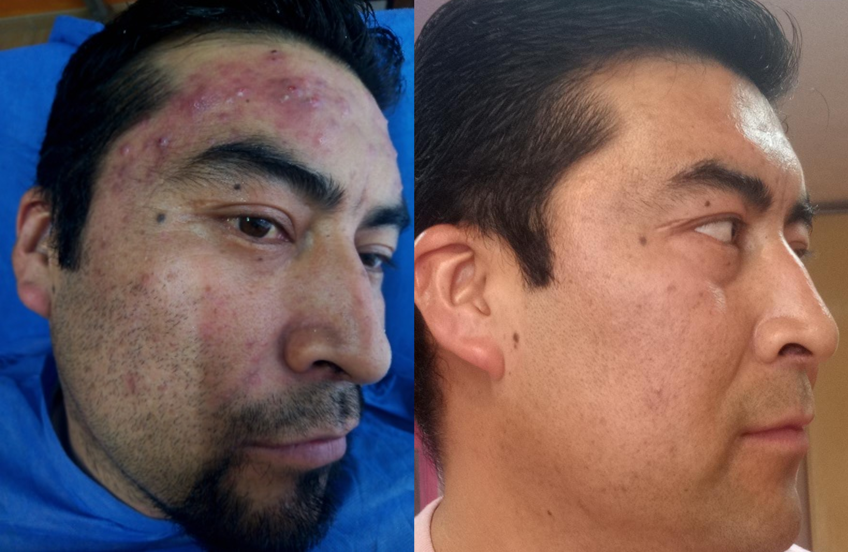 manchas post inflamatorias por acne