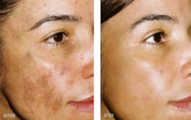 paciente con melasma en la cara en tratamiento